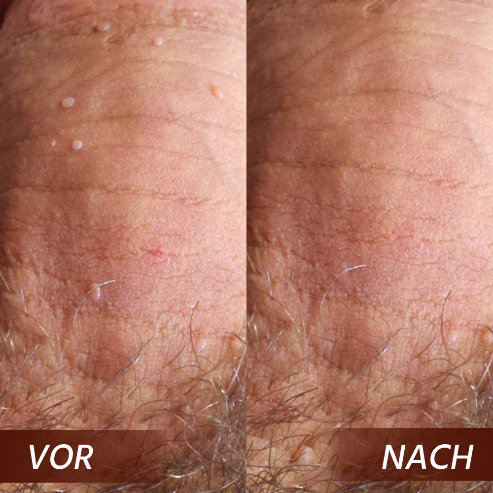 Oveallgo® AHCC Fungal HPV Genital Warts Removal Cream 8 6 2